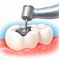 🦷 Dental Filling